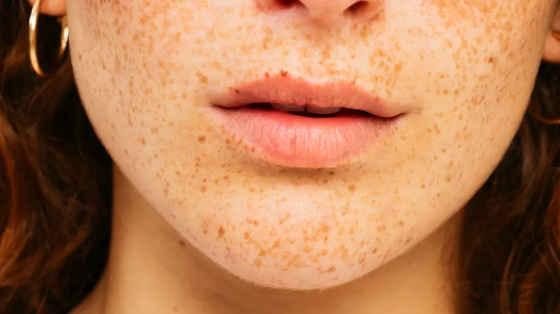چطور تفاوت لوازم آرایش اصل و تقلبی را تشخیص بدهیم؟ 4 پوست صورت پر از کک و مک یک زن