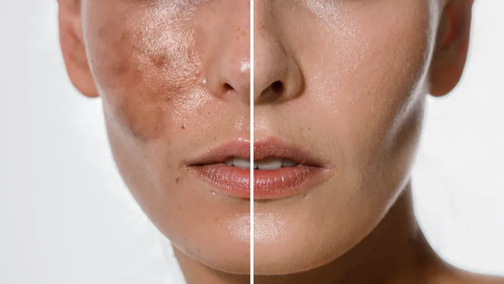 زدن روغن زیتون به صورت قبل از خواب چه فایدهای دارد؟ 6 پوست صورت یک زن، قبل و بعد از لایهبرداری